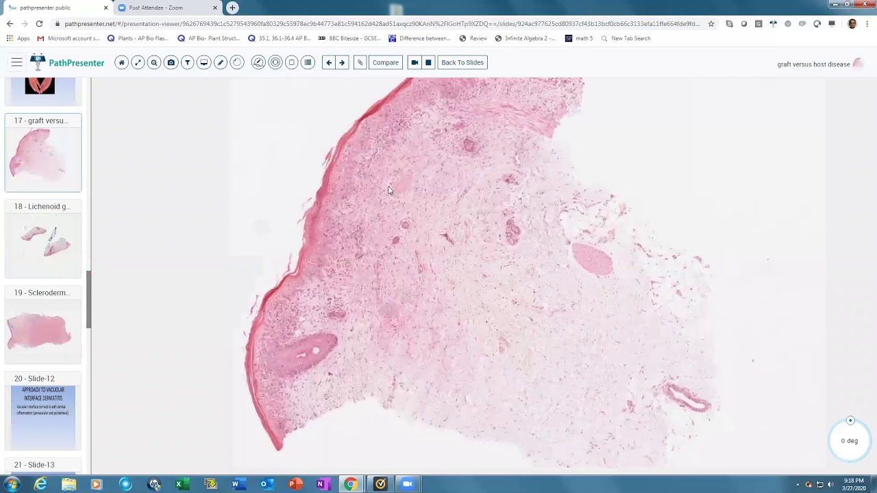 Lecture 4-Vacuolar Interface Dermatitis