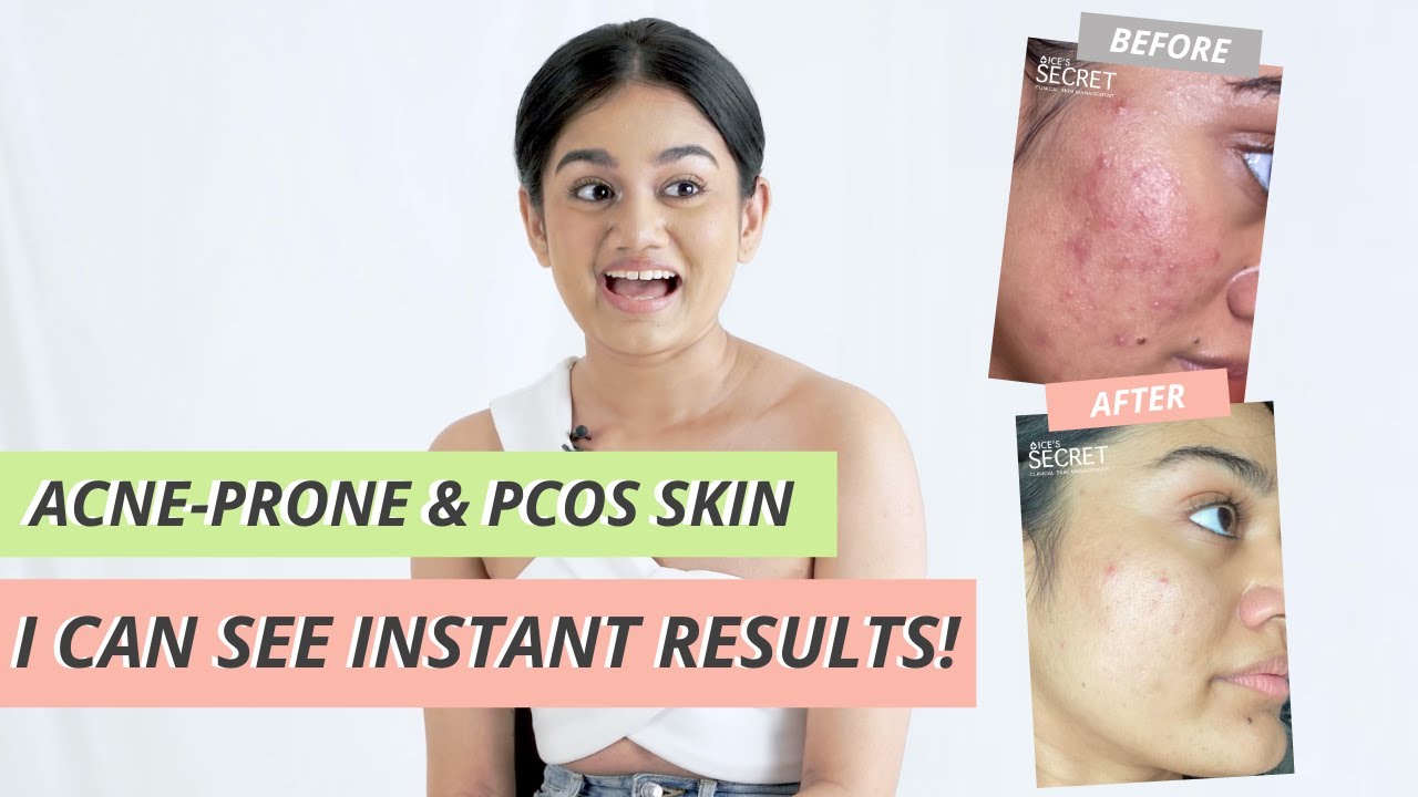 Treating PCOS Acne is Possible