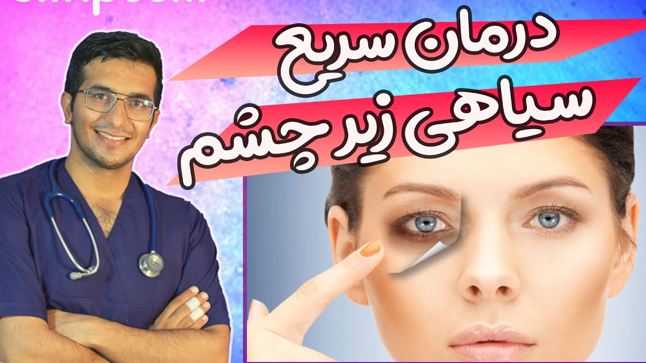 How To Get Rid Of Dark Circles Under Eyes Fast! درمان فوری سیاهی زیر چشم ها