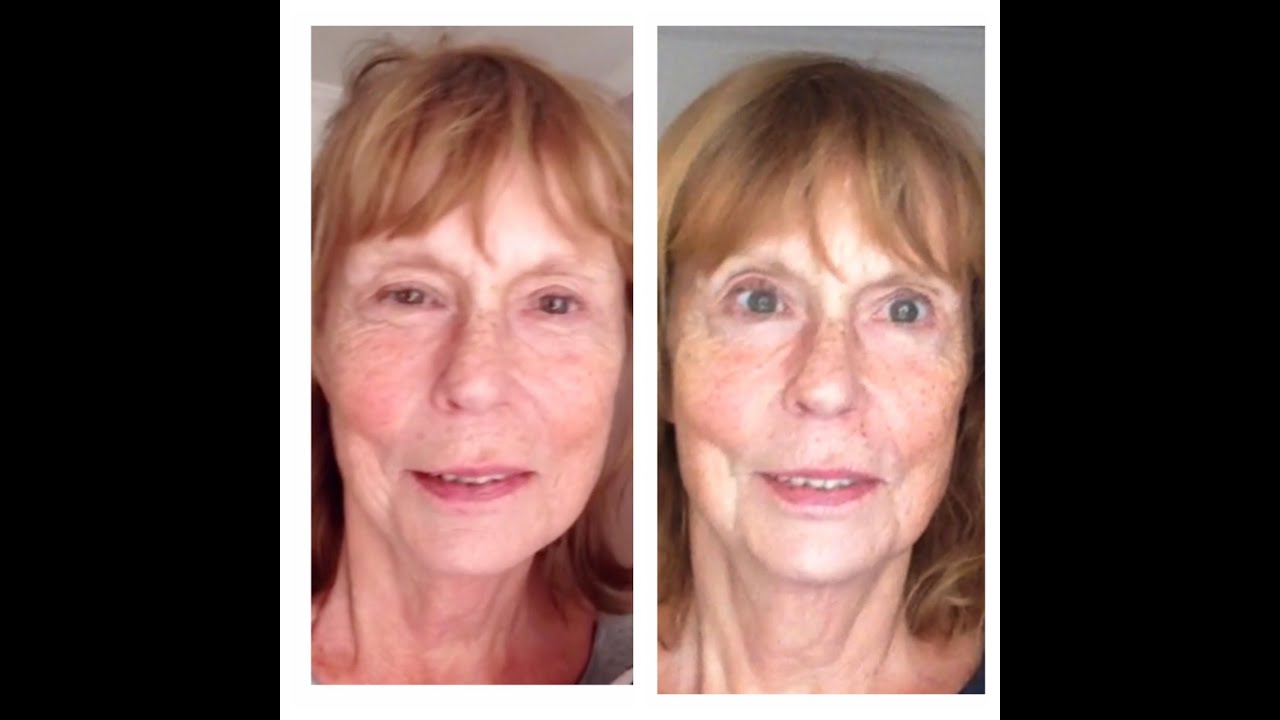 Microcurrent Facelift and the eyes: what you can expect after a series of treatments