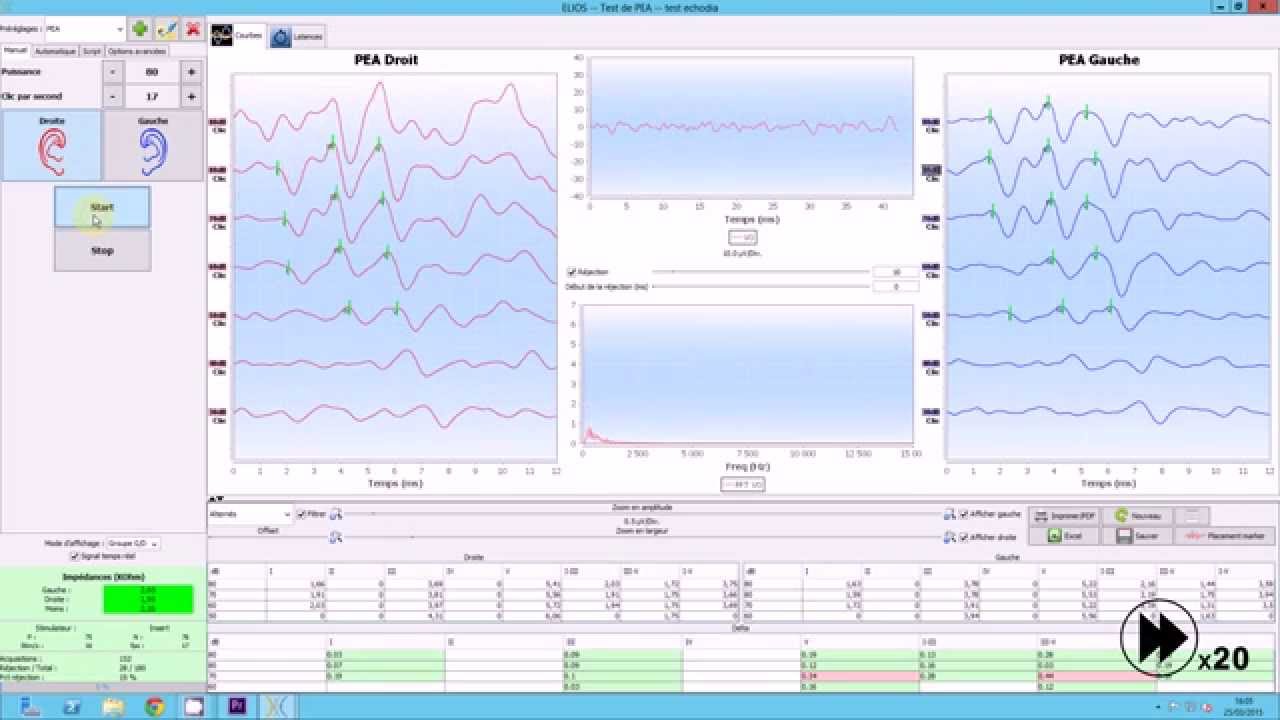Mesurer des PEA grâce au logiciel ECHOSOFT