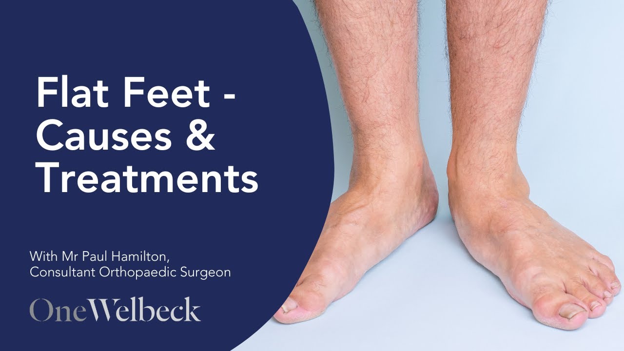 Flat Feet | Causes & Treatment