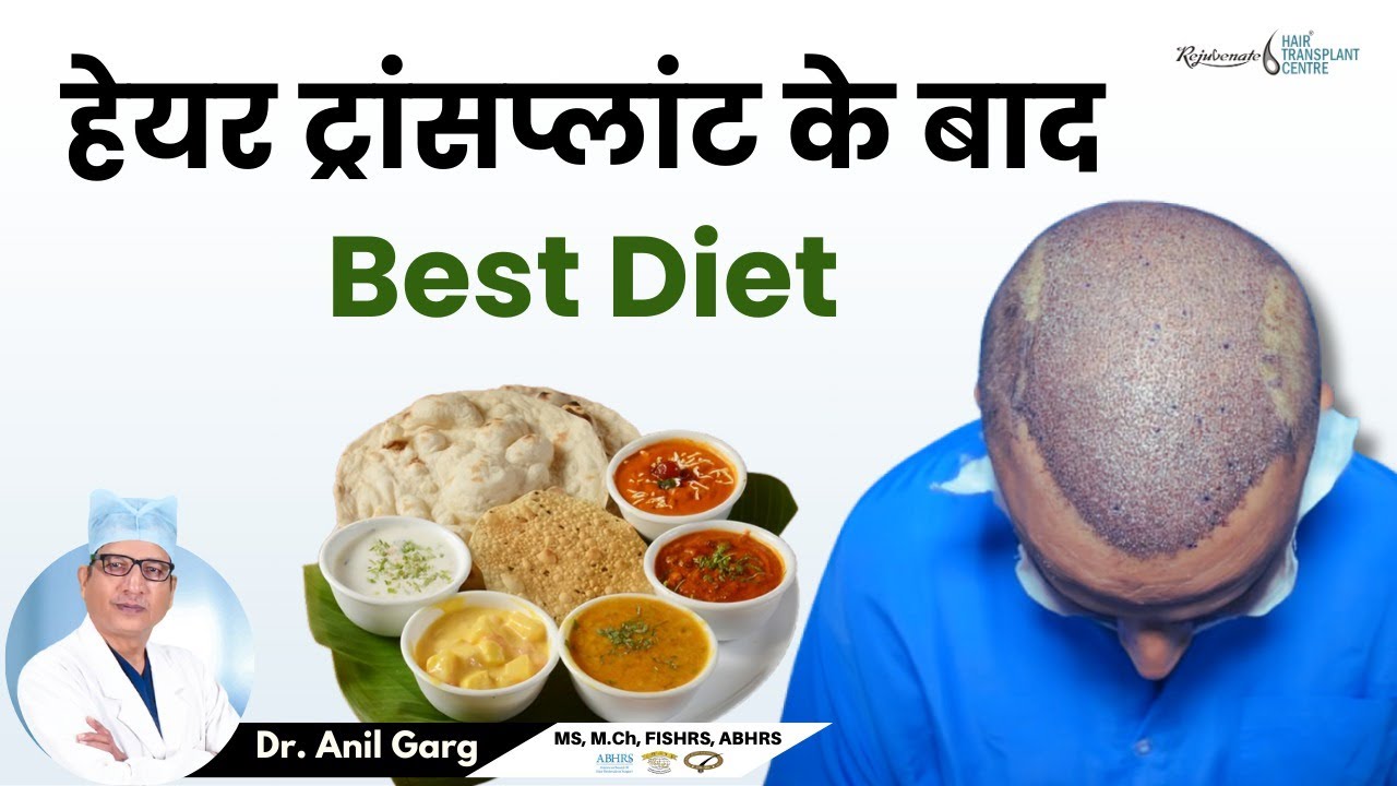 Hair Transplant Diet Secrets from a PROFESSIONAL Stylist | Best Diet After Hair Transplant