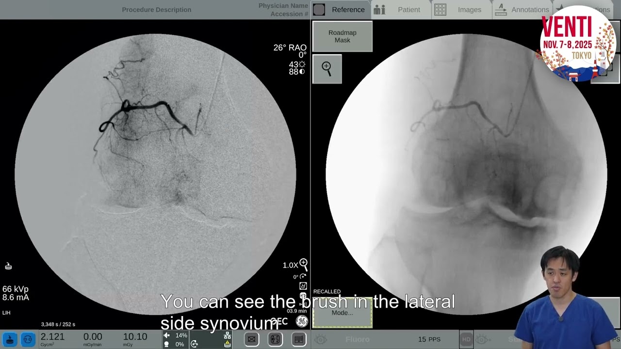 Knee Osteoarthritis Treatment | Embolization Procedure Explained (Real Patient Case)