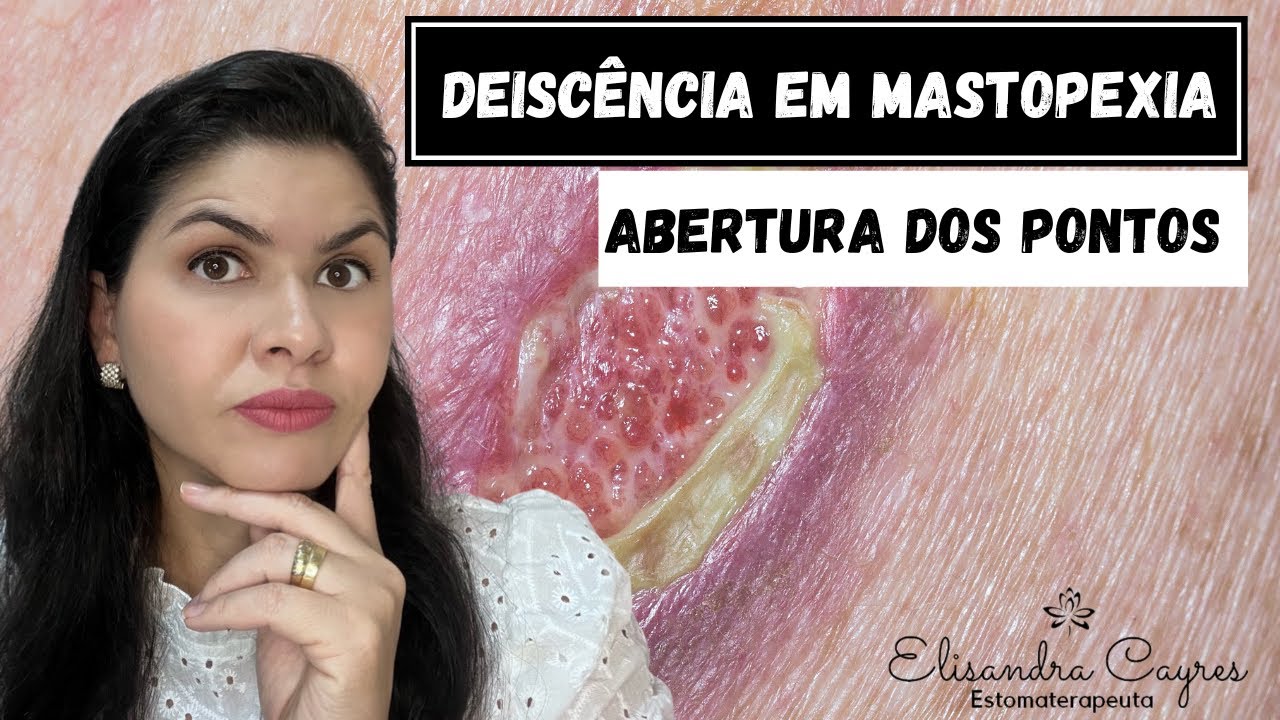 DEISCÊNCIA EM MASTOPEXIA - ESTOMATERAPIA