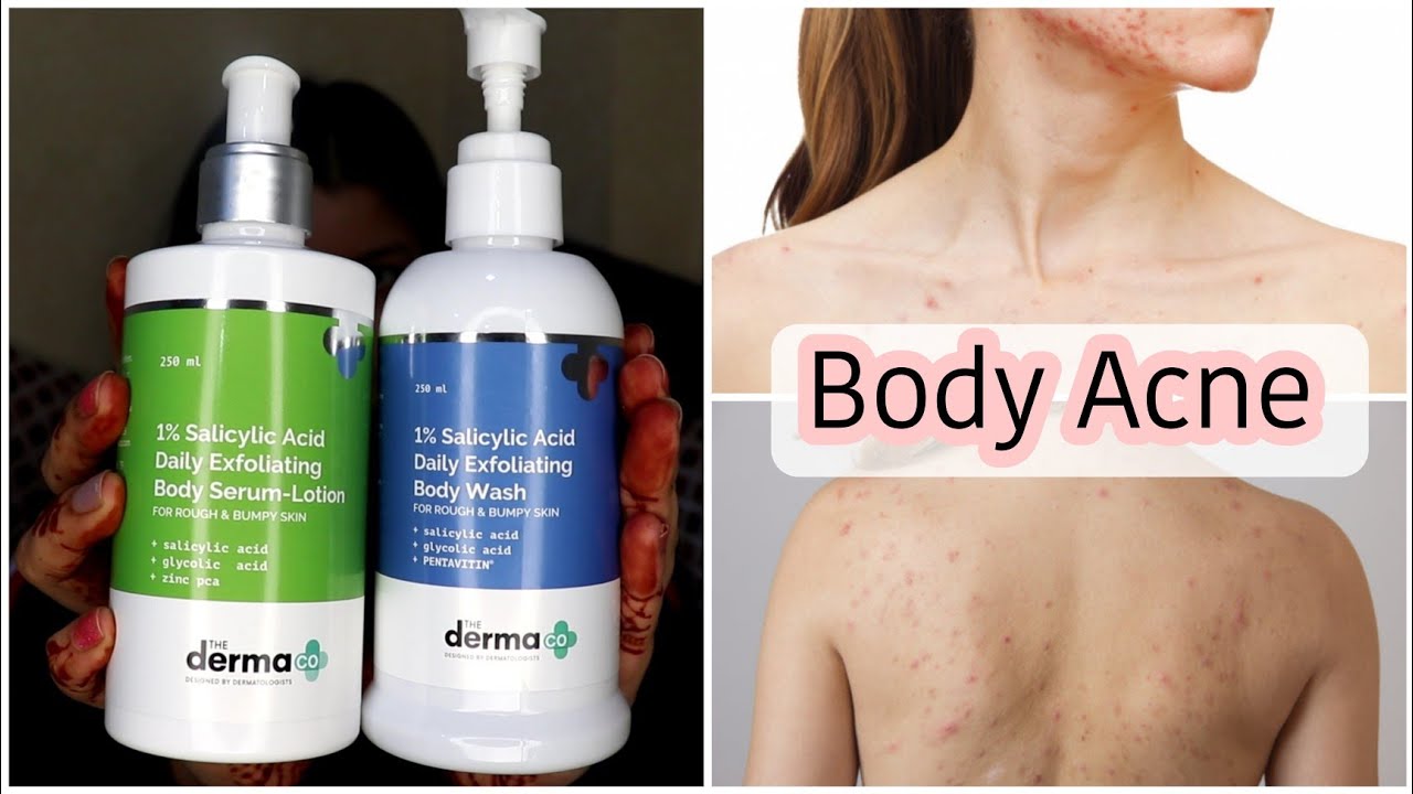 Body Acne - Backne, Acne on Chest, Shoulders, Buttocks - Solutions
