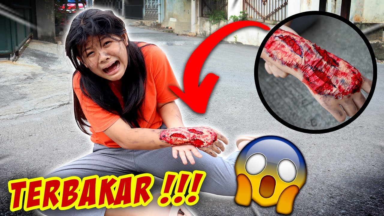 TANGAN CHIARA TERBAKAR !! SAKIT PERIH AMPE NANGIS 😱GARA-GARA...