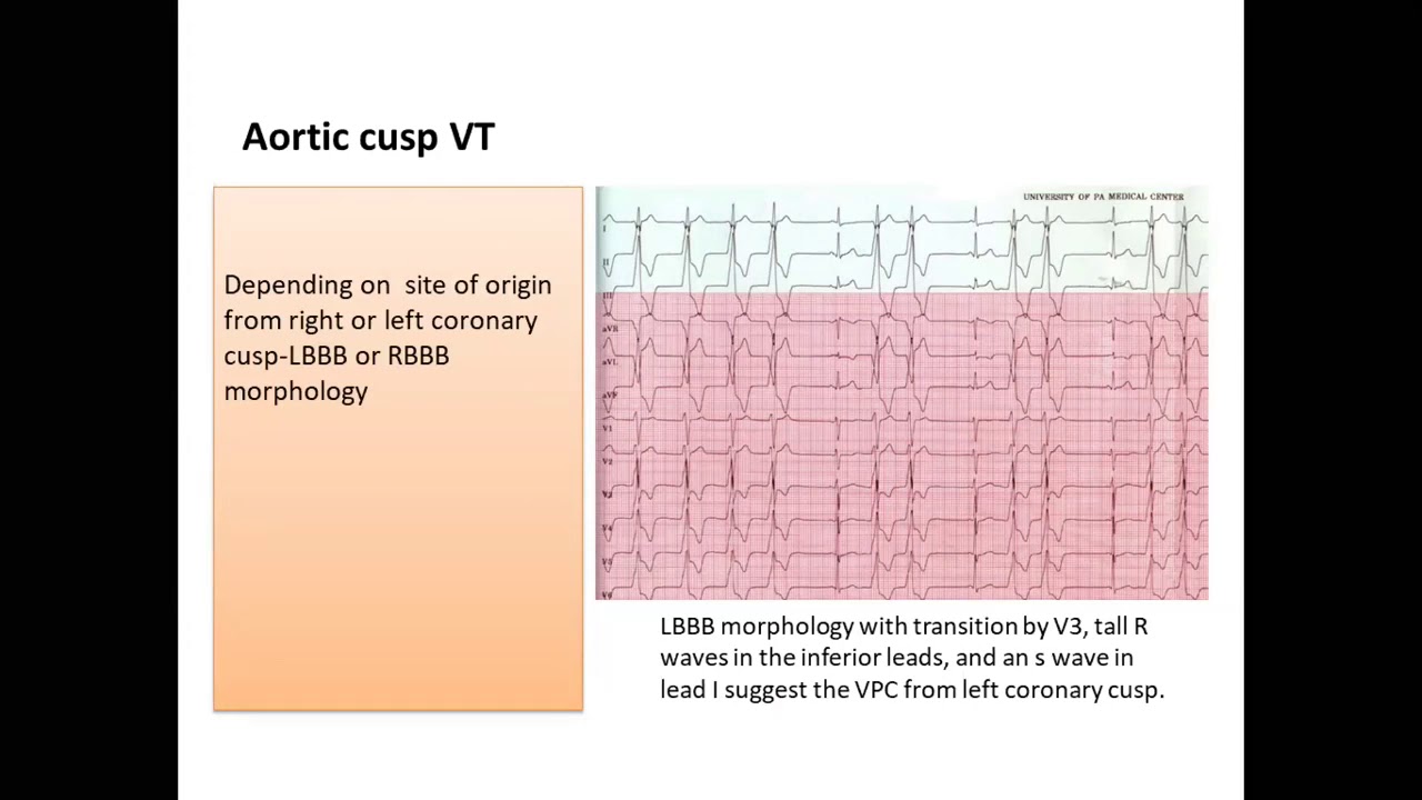 ablation of idiopathic PVCs   VT -  Dr  John Kamal