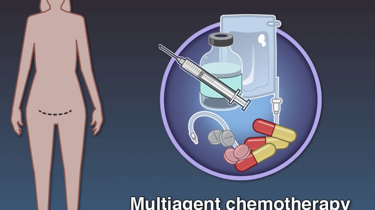 Lymphadenectomy and Survival in Ovarian Cancer