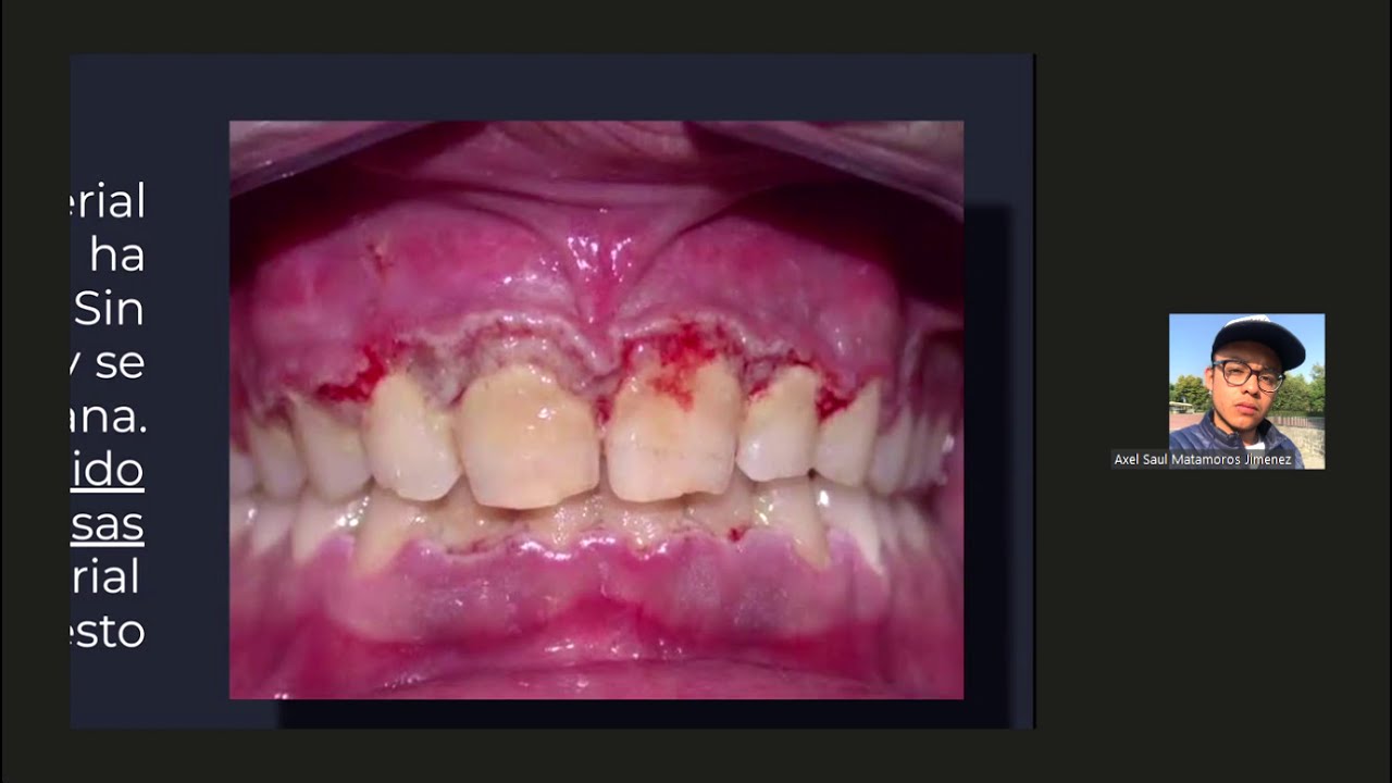 Enfermedad Periodontal Necrotizante