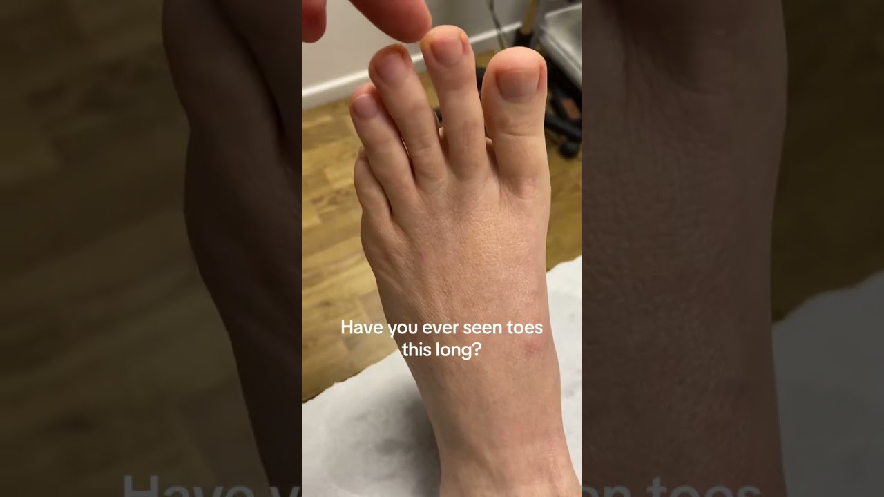 Have you ever seen toes this long? #fingersfortoes #docpods #ergonx #footpain #longtoes #podiatrist
