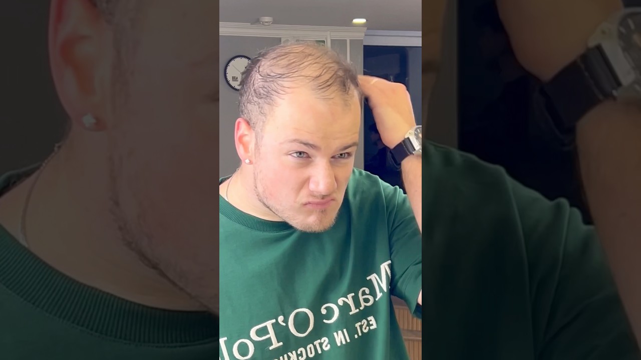 Bald & Thinning Hair Transformation | Hair Fibres 