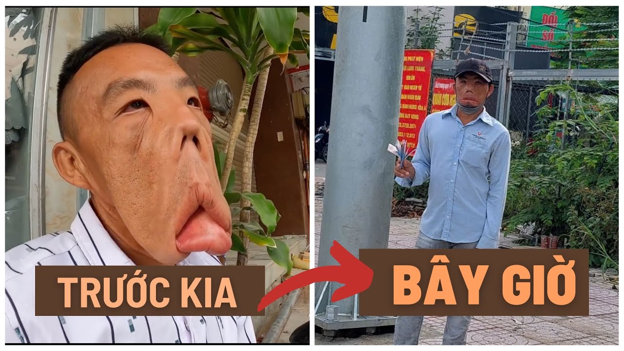 Cưới vợ xong chàng trai có khuôn mặt dị dạng bây giờ cuộc sống đổi thay sau được bác sĩ cứu giúp