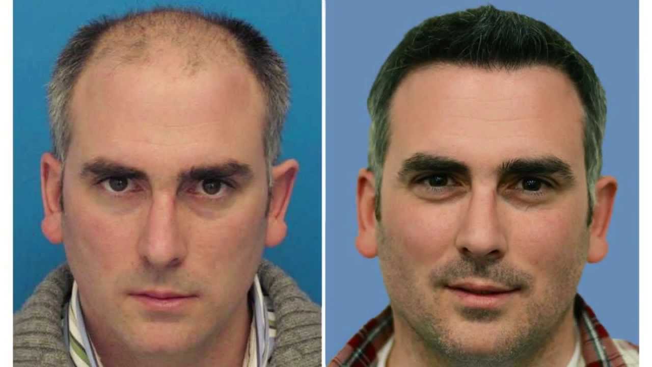 Hair Transplant Mind blowing results