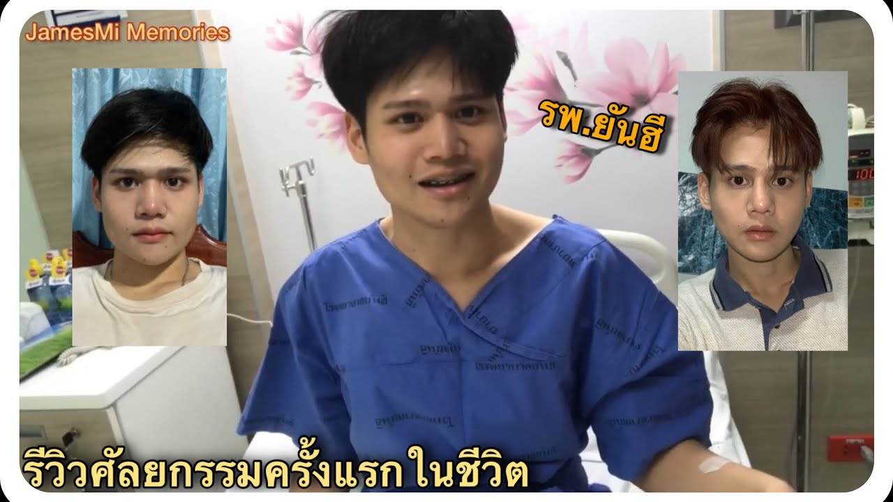 รีวิวศัลยกรรมครั้งแรกในชีวิต (ตัดกราม+ทำจมูก) รพ.ยันฮี |JamesMi Memories