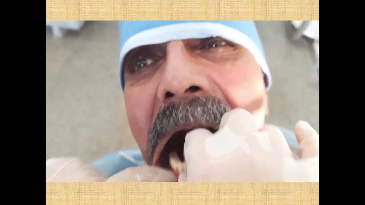 Insertion of complete denture