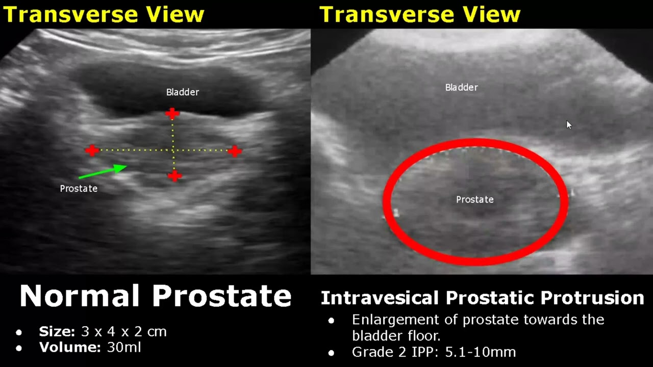 Prostate Ultrasound Normal Vs Abnormal Image Appearances | Transrectal (TRUS) & Transabdominal USG