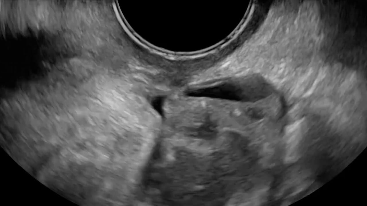 Video 10: Small uterosacral ligaments in deep endometriosis in ovarian endometrioma