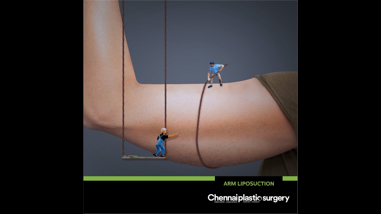 High-Definition Arm Liposuction | Circumferential Arm Liposuction | Dr.Karthik.R - India