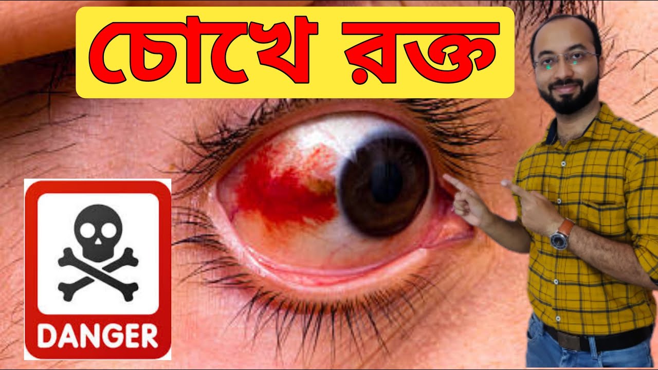 চোখে রক্ত জমে যাবার কারণ | চোখে রক্ত জমলে করণীয় | Blood Clot In Eyes | Sub Conjunctival Hemorrhage