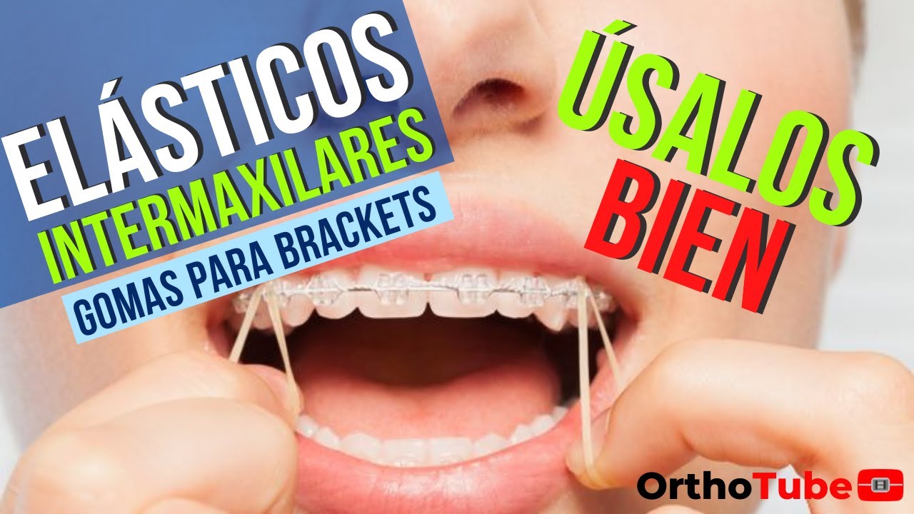 ¿PARA QUÉ SIRVEN LOS ELÁSTICOS INTERMAXILARES?  | 😲 ELIMINA tus DUDAS / EXPLICACIÓN DEFINITIVA 😎