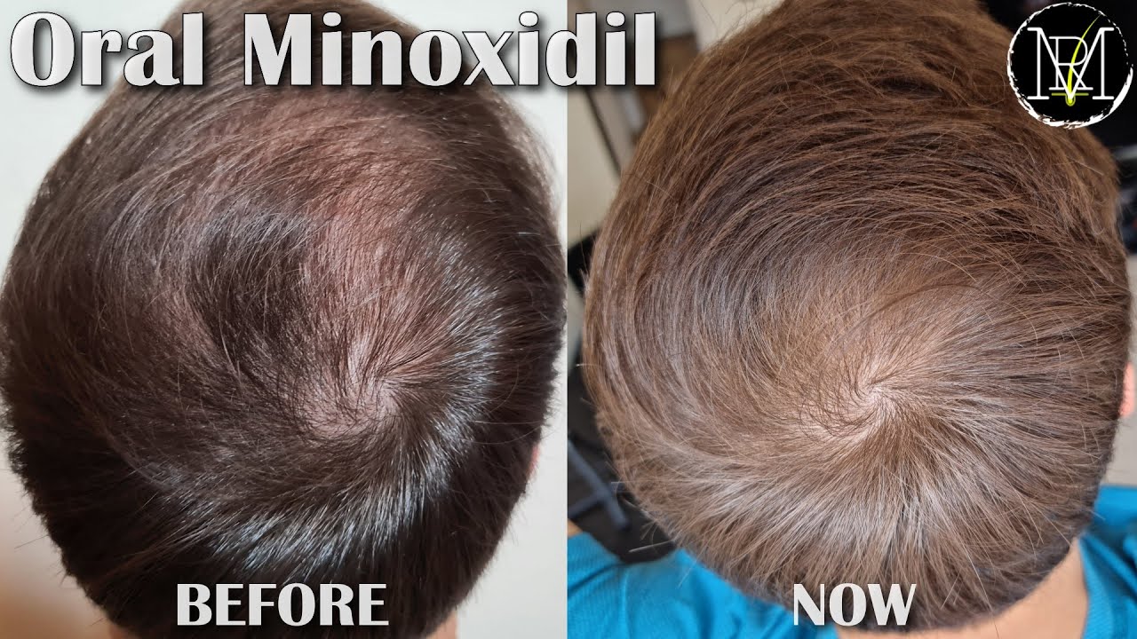 Oral Minoxidil (Loniten) Results in 10 Months