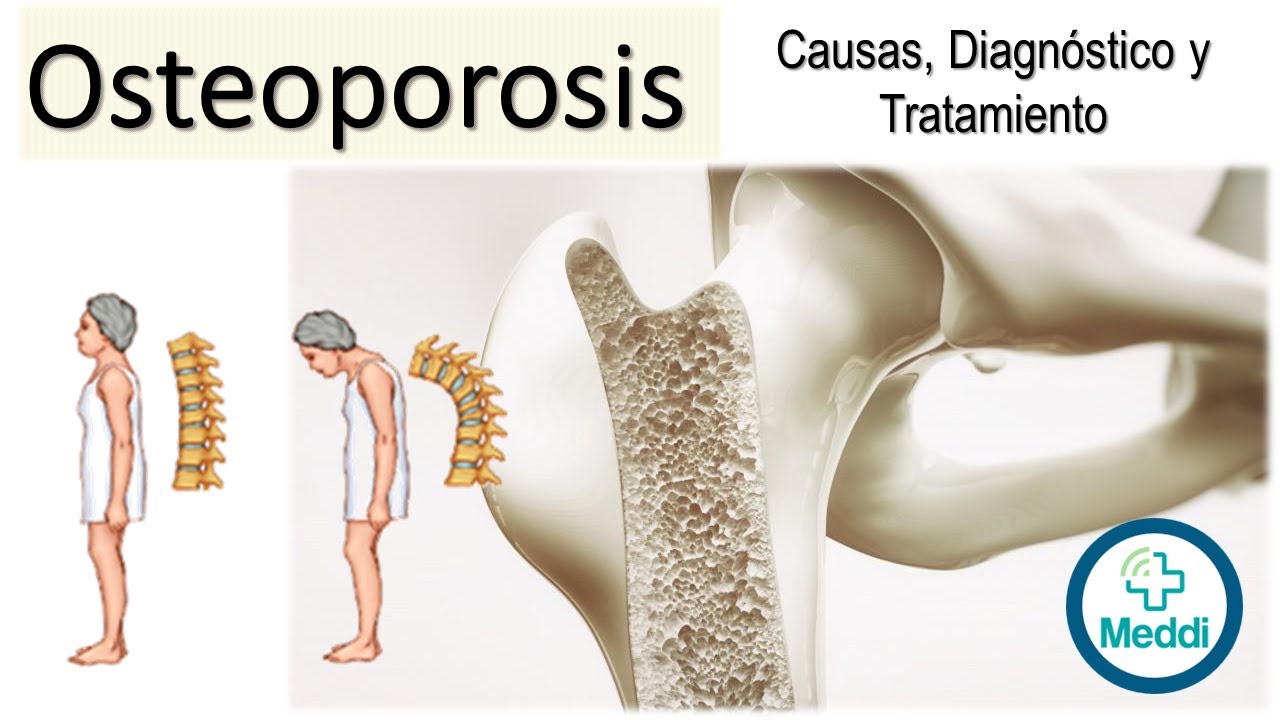 Osteoporosis: Causas, Diagnóstico y Tratamiento. COMPLETO.