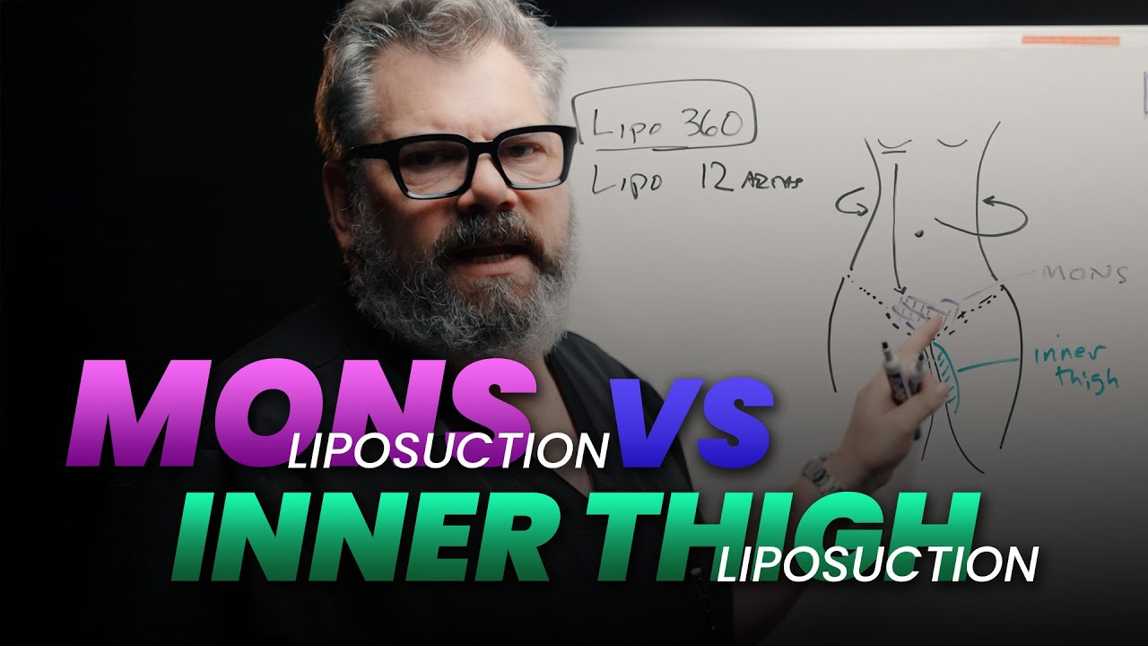 Enhancing Lipo 360: Mons Liposuction vs Inner Thigh Lipo