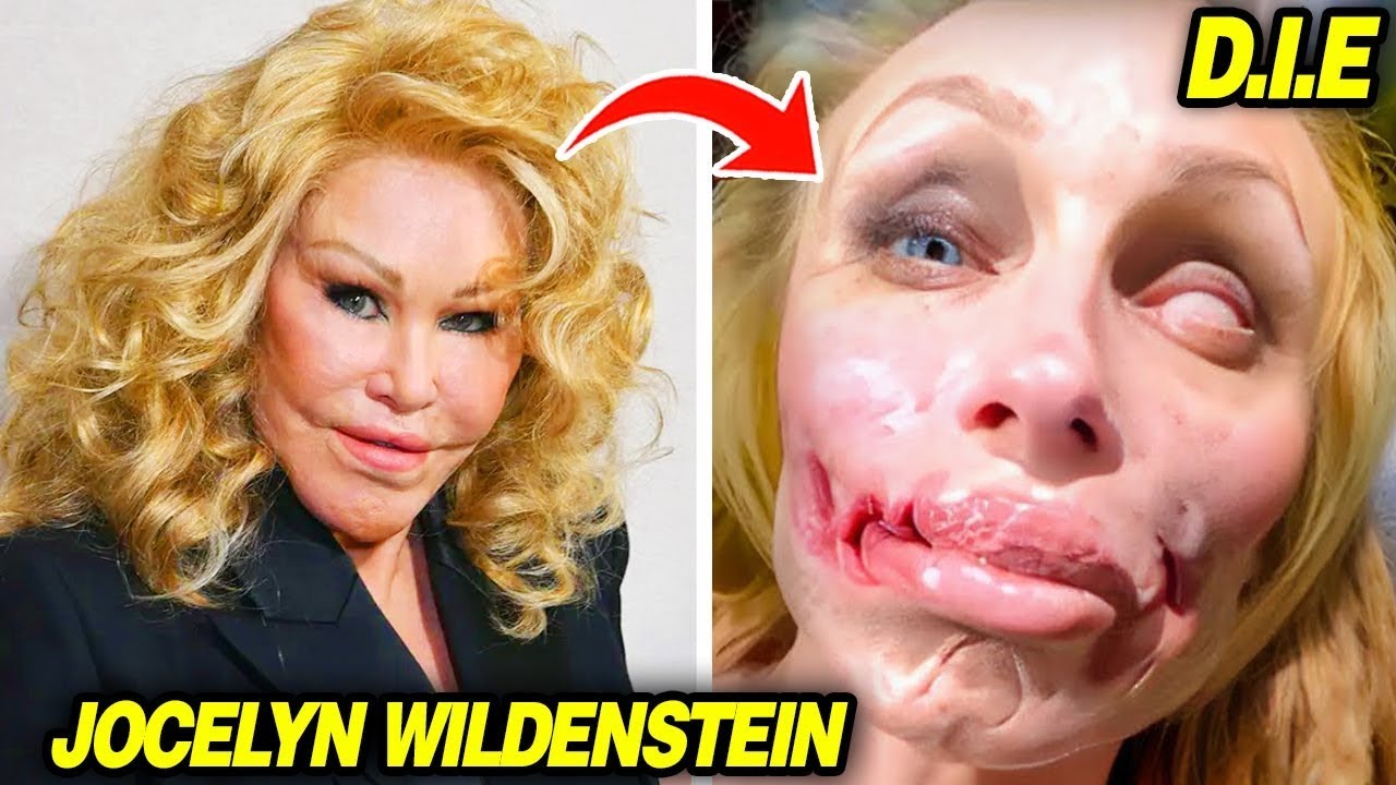 13 Celebrities     Whose Bodies Were Ruined by Plastic Surgery Just for Fame