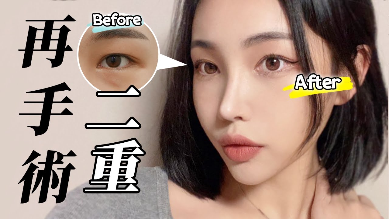 【修正手術】目再手術ってどうするの？形成外科医が症例写真を付きで比較解説!【韓国整形】
