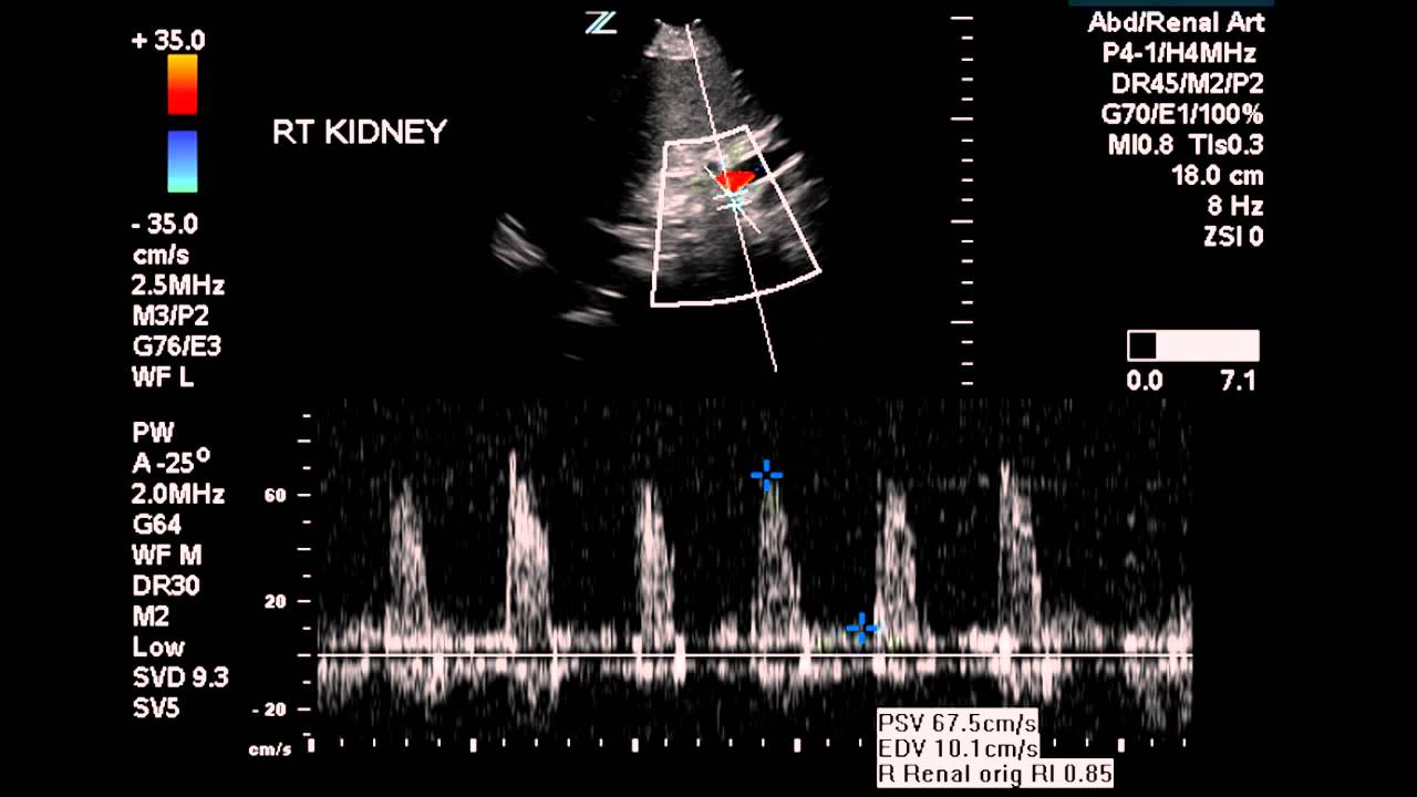 Normal Renal Artery Flow - Case Study