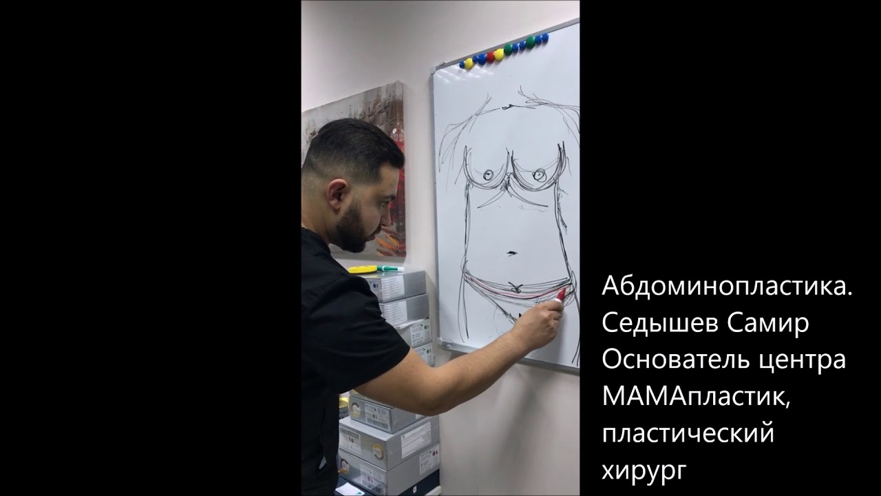 Абдоминопластика. Ответы на вопросы. Ход пластической операции.