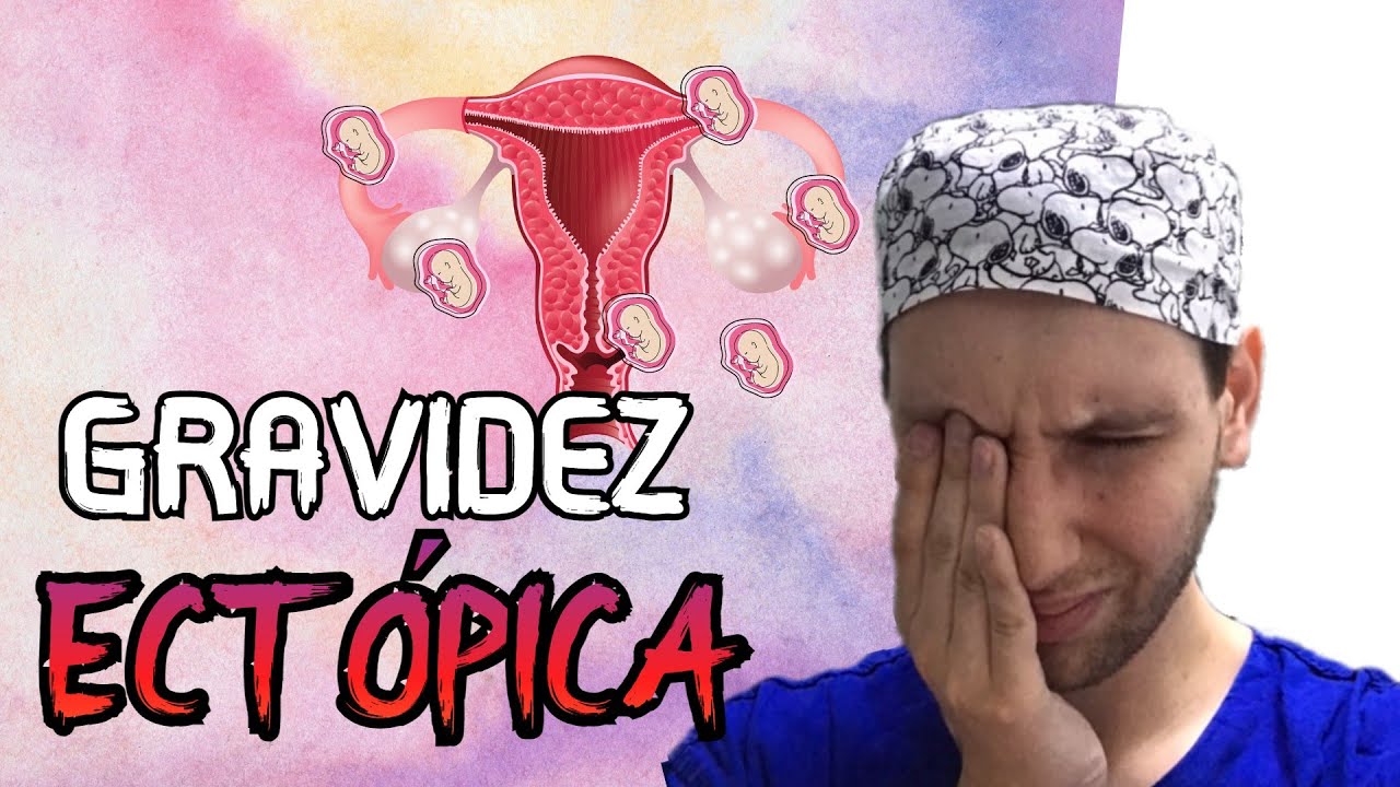 ENTENDA: GRAVIDEZ ECTÓPICA o que é, causas, sintomas, tratamento.