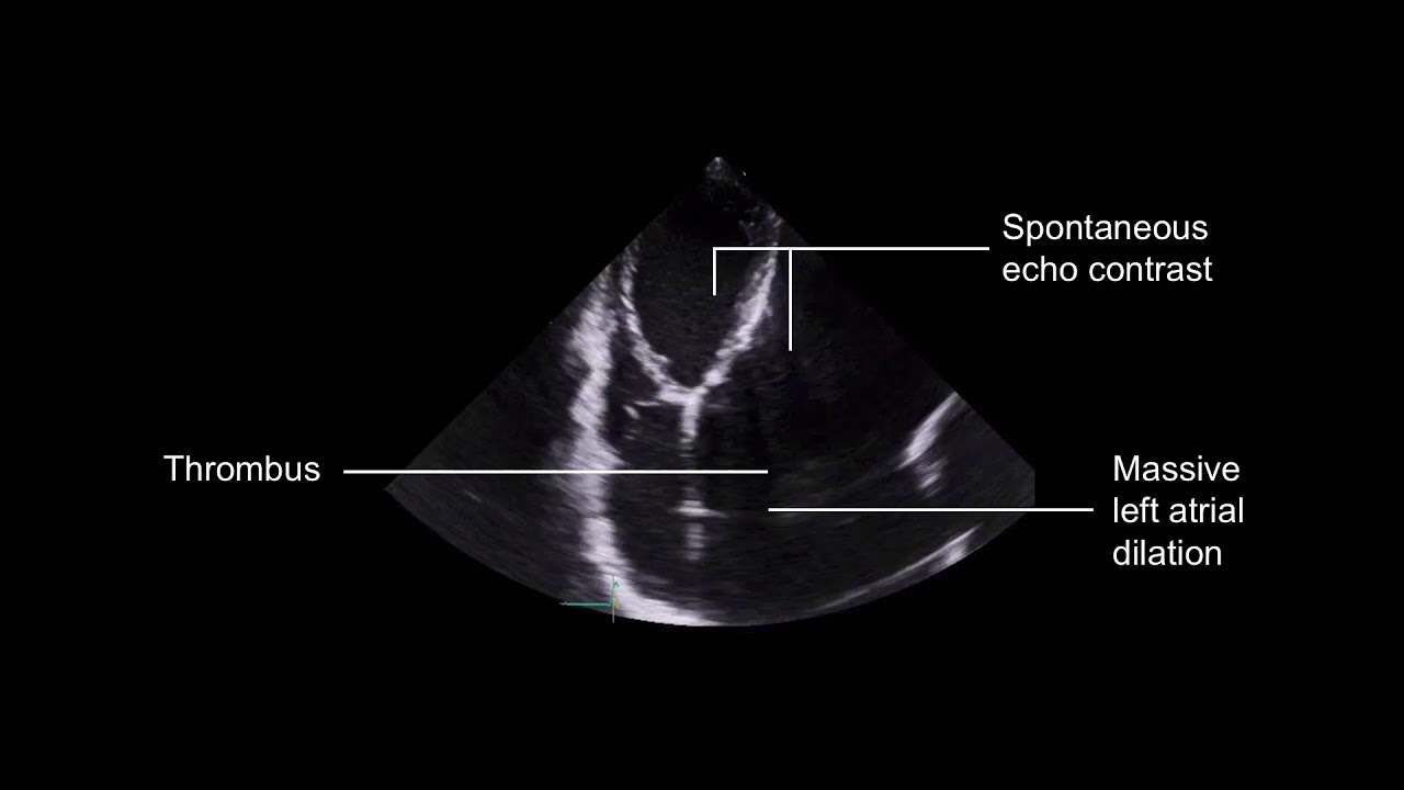 Grading mitral stenosis
