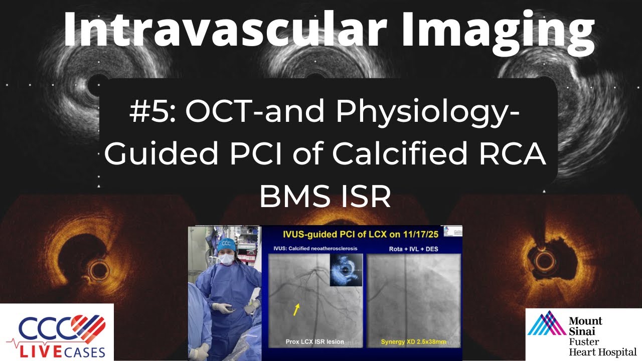 OCT-and Physiology-Guided PCI of Calcified RCA BMS ISR