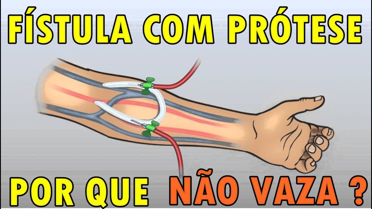 Fístula com PRÓTESE: Por Que NÃO VAZA Após a Hemodiálise ? | Cortes Renais Ep. 37