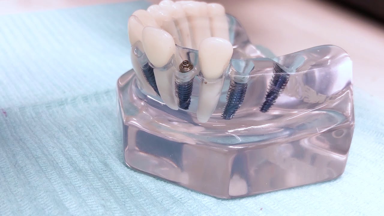Micro Pilar Grand Morse Neodent