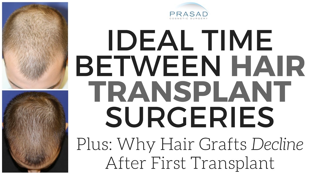 How to Plan a Second Hair Transplant, Improve Results, and Avoid a Second Transplant
