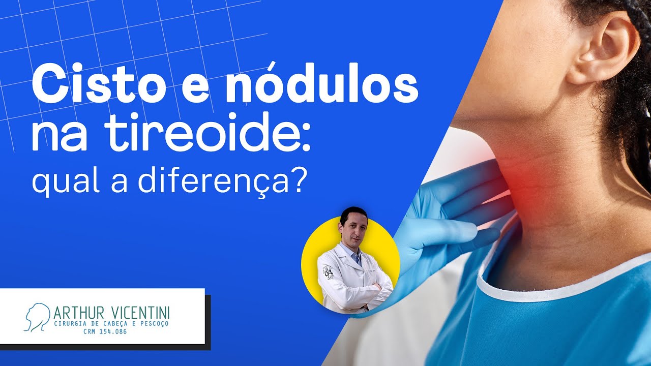 Cisto e nódulos na tireoide: qual a diferença? | Dr. Arthur Vicentini CRM 154.086