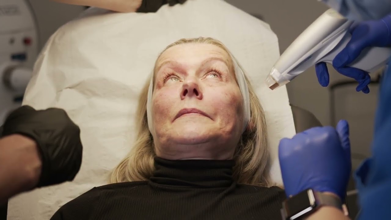 Sublative Fractional Radio Frequency Treatment Demo at Quinn Clinics Bristol