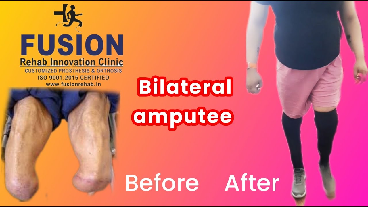 Bilateral below knee prosthesis 88267 12631, 97117 49392 