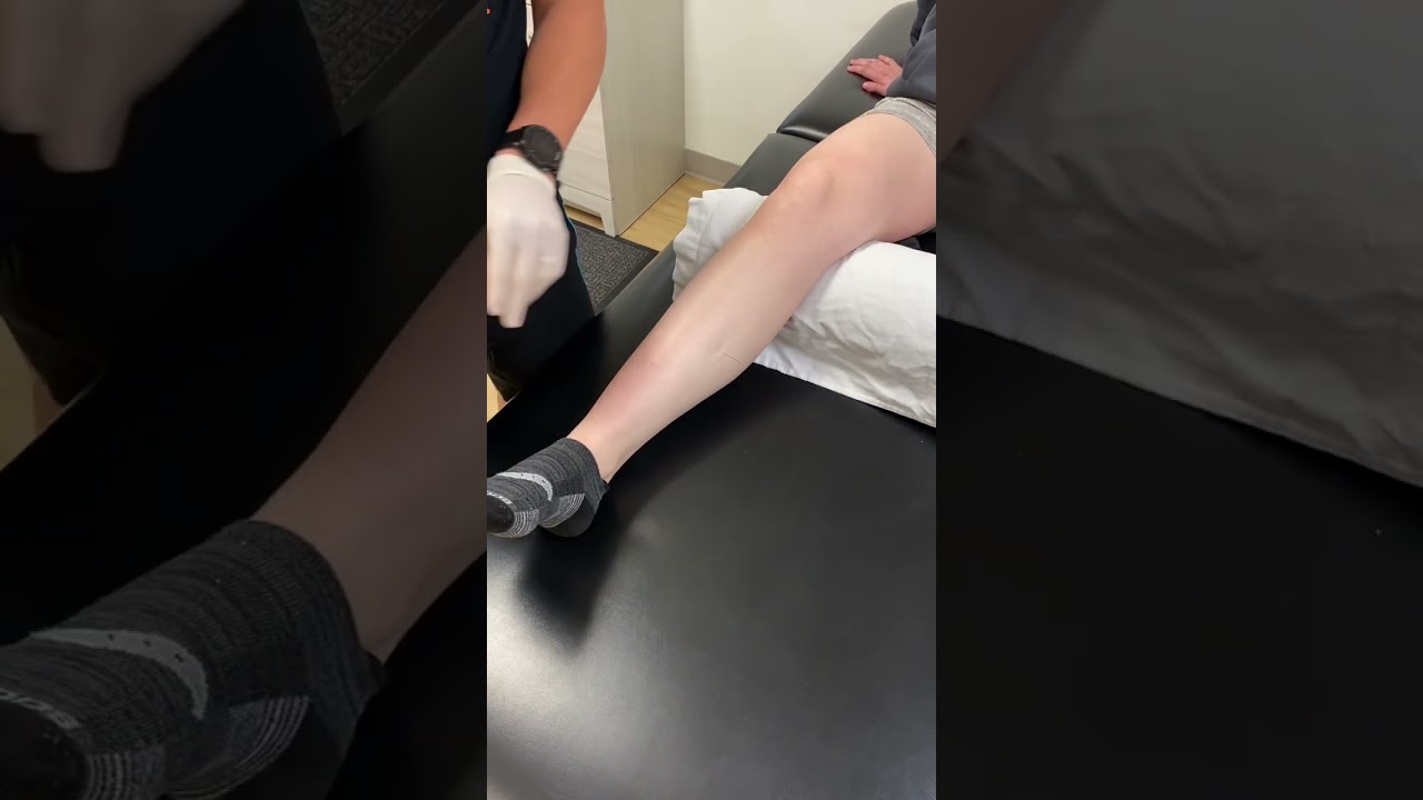 Dry needling for shin splints, posterior tib focus.
