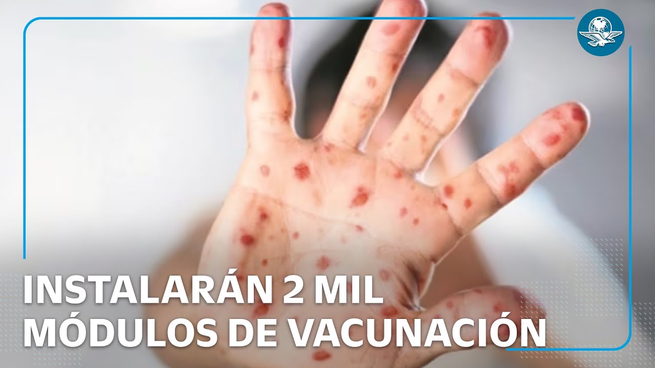 Anuncian gran campaña de vacunación contra el sarampión en CDMX