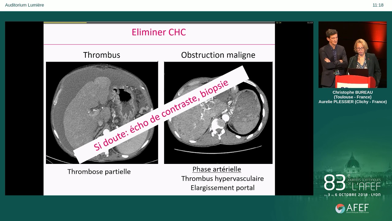 Recommandations 2018 de l'AFEF sur les Maladies Vasculaires du Foie - C. BUREAU A. PLESSIER