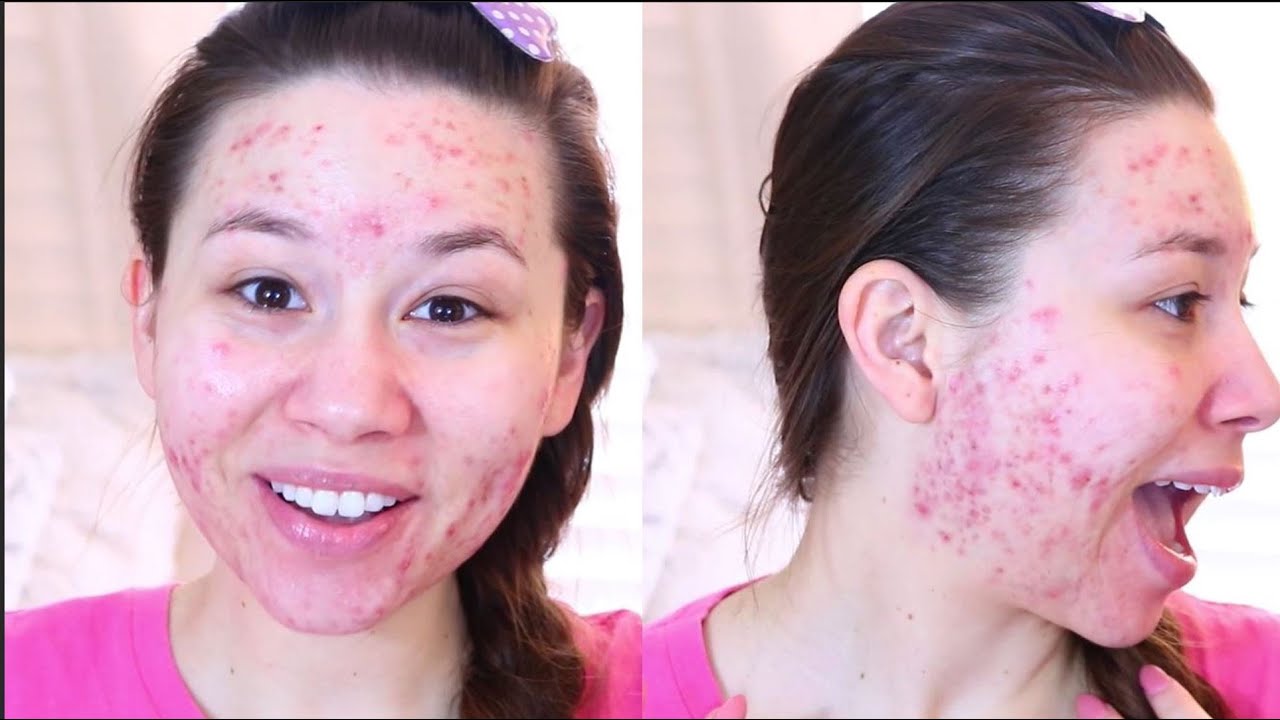 My STRUGGLES with ACNE & DRUGSTORE FOUNDATION Routine