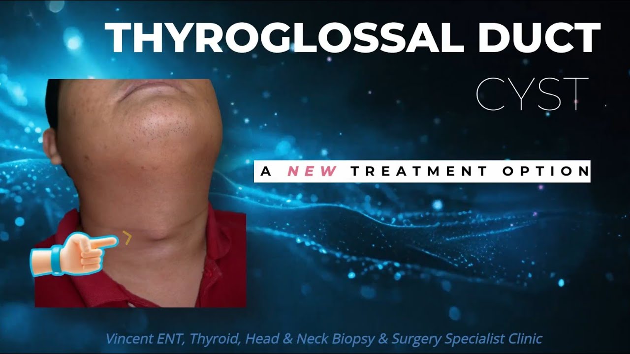 Thyroglossal duct cyst (TGDC) Chemical Ablation: Percutaneous Ethanol Injection (PEI)