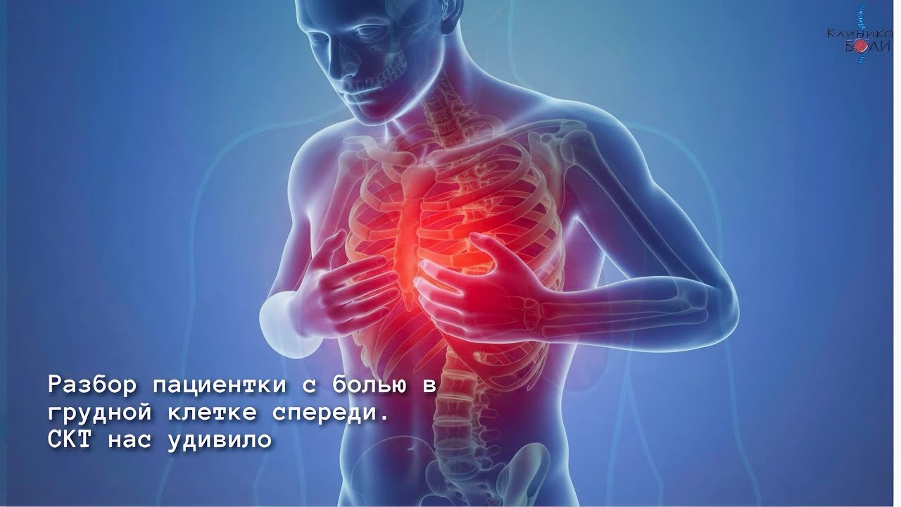 Разбор пациента с болью в грудной клетке спереди. СКТ нас сильно удивило 