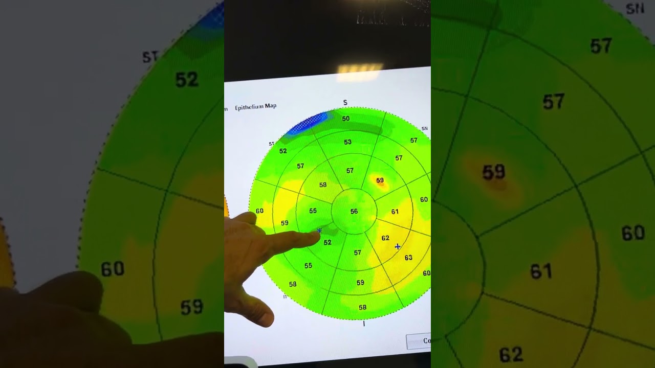 How to design an AthensProtocol CXL for keratoconus-live from our laser-room: Kanellopoulos, MD