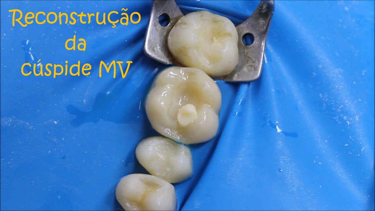 Restauração Cl I em RC no dente 16 (manequim)