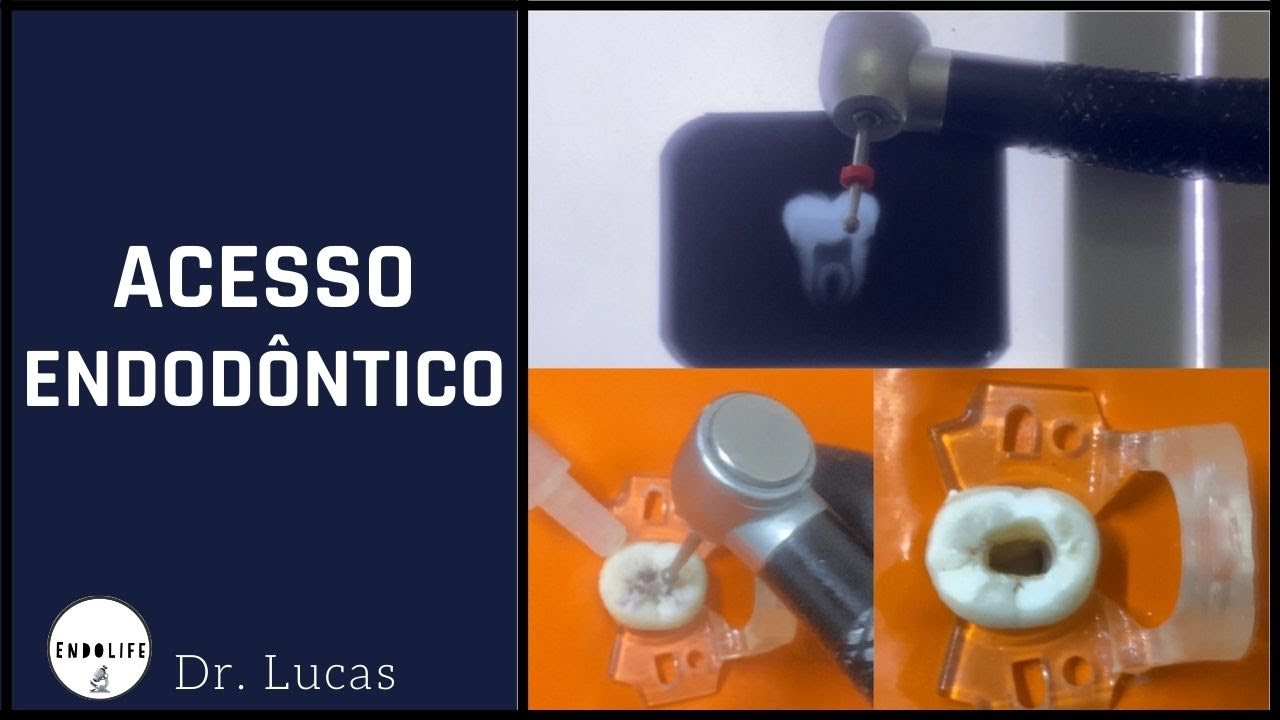 ACESSO ENDODÔNTICO.